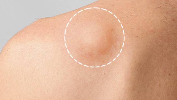 Lipoma(脂肪瘤) - 楊浩康醫生專業解讀