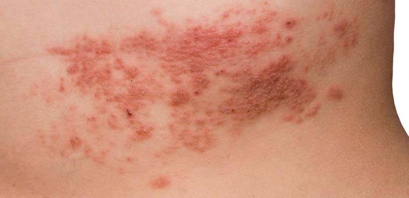 Shingles, herpes zoster - 楊浩康醫生專業解讀