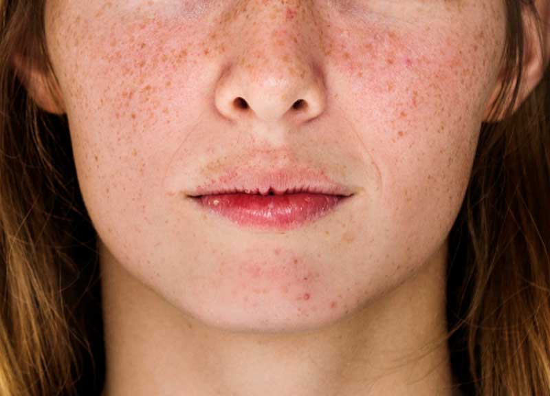 Rosacea(玫瑰痤瘡) - 楊浩康醫生專業解讀